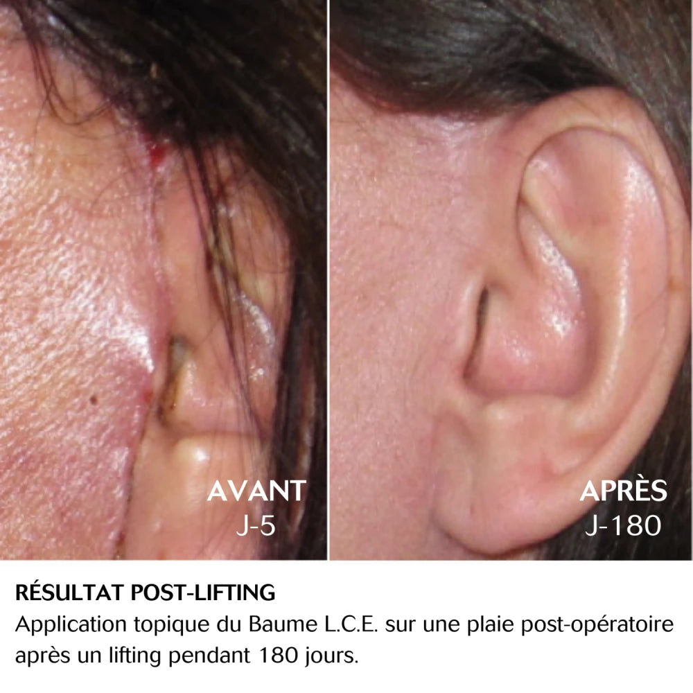 Cebelia LCE Balm-before after