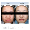 hydrafacial before and after-hydrafacial toronto-signature cosmetic clinic
