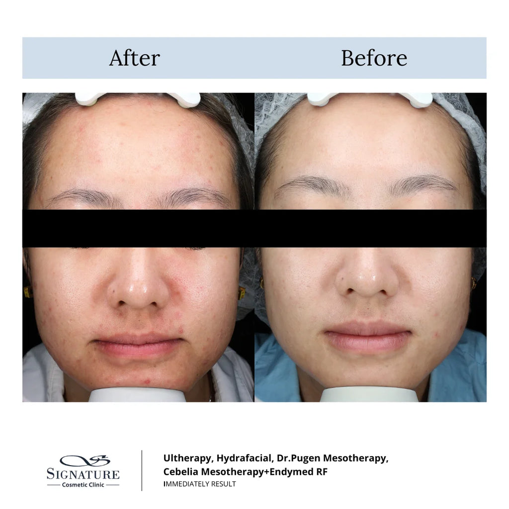 hydrafacial before and after-hydrafacial toronto-signature cosmetic clinic