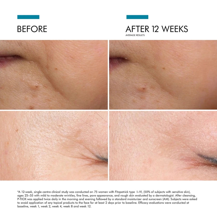 p tiox before and after-skinceuticals p tiox-skinceuticals toronto