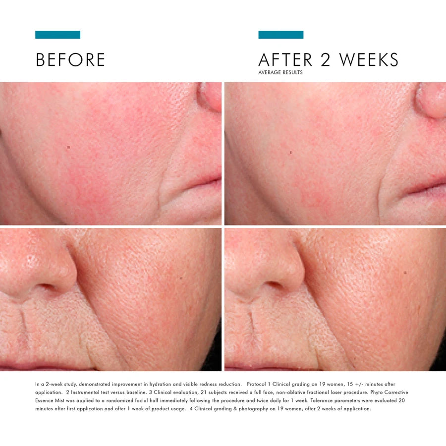Phyto Corrective Essence Mist-Skinceuticals serum-before after results