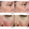 clear and brilliant before and after-clear and brilliant laser toronto